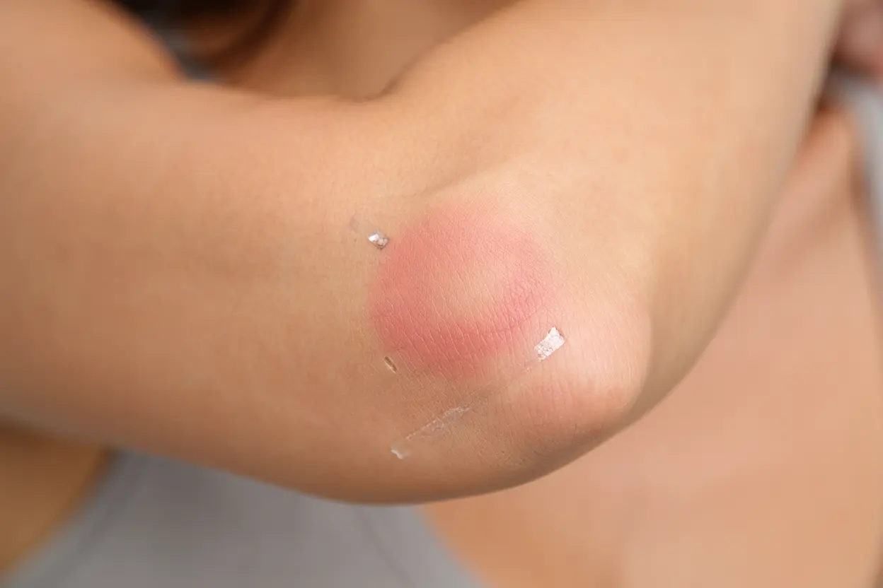 Rougeur légère après électrostimulation